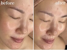 ホワイトアクア 浜松店(WHITE AQUA)/ララピール/ニキビケア