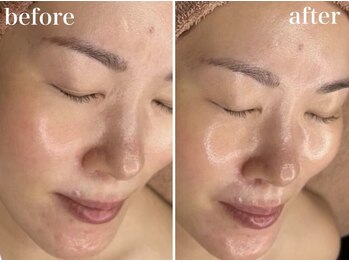 ホワイトアクア 浜松店(WHITE AQUA)/ララピール/ニキビケア