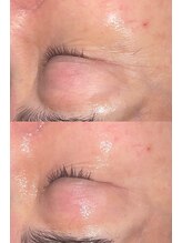 クレアナ ザ ビューティー(KULEANA the beauty)/LDMリフティング&幹細胞導入