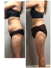 ぐりーんりぷる/フォースカッター上半身x3回