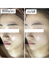 ホワイトアクア 岐阜店(WHITE AQUA)/ハーブピーリング/岐阜/ニキビ