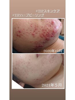 ソリッジ肌管理室/大人気ニキビケア