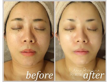 アン グレーヌ 自由が丘(unegraine)/若々しさを取り戻す♪