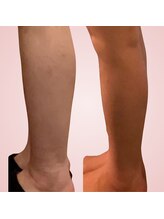 シエスタ(SIESTA)/Before→After 　ふくらはぎ