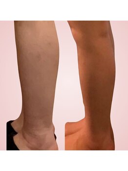 シエスタ(SIESTA)/Before→After 　ふくらはぎ