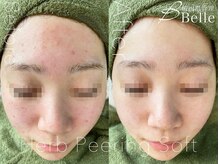 ベル 門前仲町(Belle)/ハーブピーリング|ニキビケア