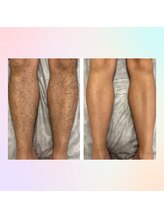 フレイヤビューティー スハダラボ 恵比寿(Freyia Beauty Suhada LABO)/-美肌全身脱毛-恵比寿