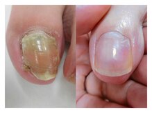 巻き爪ケアサポート ルアナ(LUANA)/Before→After