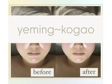 エミング(yeming)の雰囲気（小顔コルギ(Before/after)フェイスライン、歪みをスッキリ！）