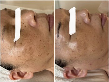 フォー(For...)/シミケア|ピーリング|天王寺