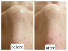 カレン アイビューティー(Karen Eyebeauty)/ララピールで鼻の角栓スッキリ☆