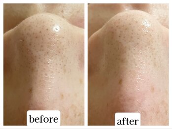 カレン アイビューティー(Karen Eyebeauty)/ララピールで鼻の角栓スッキリ☆