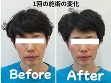 ゆず鍼灸整骨院/当院人気NO1！美容鍼モニター様