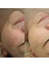 リラ 郡山店(Lilas)/赤みのケアにもララピール