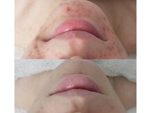 プシュケ(Psyche)/お客様の肌変化