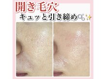 ホワイトアクア 天王寺本店(WHITE AQUA)/ハーブピーリング/大阪/天王寺