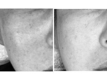 アストリア(ASTORIA)/幹細胞エクソソーム