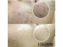 メンズサロンエヌエー(MEN'S SALON NA)/【顔全体のムダ毛がいらない方】