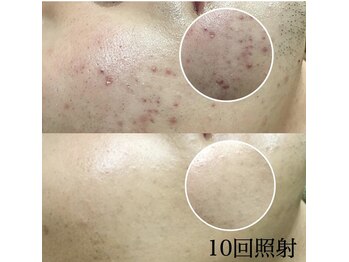 メンズサロンエヌエー(MEN'S SALON NA)/【顔全体のムダ毛がいらない方】