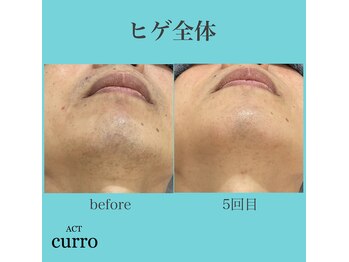 アクト クロ(ACT curro)/【ヒゲ全体】脱毛施術例