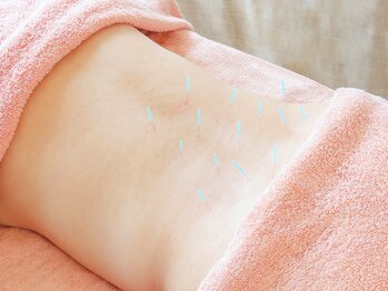 鍼灸治療院ヒカリ(hikari)/【鍼灸】３．施術