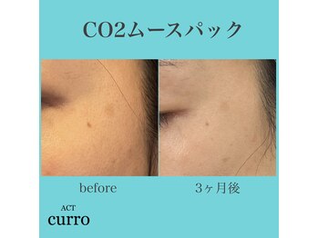 アクト クロ(ACT curro)/CO2ムースパック経過