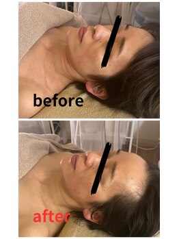 アコルデ(Acorde)/コルギの施術前後