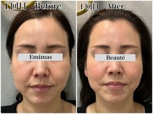 エミマス ボーテ(Emimas Beaute’)/４０代前半　小顔矯正＆毛穴洗浄
