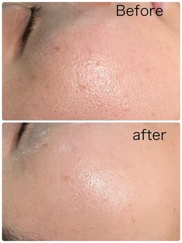 ルミネル 名古屋新栄(Luminelle)/毛穴ごっそり