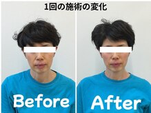 ゆず鍼灸整骨院/美の相乗効果！美容鍼×姿勢改善