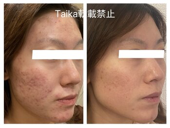 タイカ(Taika)/長年悩み卒業へ！ニキビケア改善