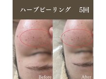 サロンドペシェ(salon de peche)/ハーブピーリング5回の変化