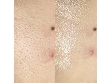 ベルミーランド MEGAドン・キホーテ草加の雰囲気（毛穴ケアBeforeAfter）