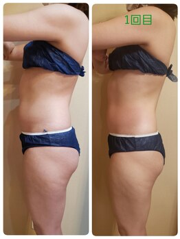 コハサロン(COHA SALON)/痩身お腹1回のBefore→After