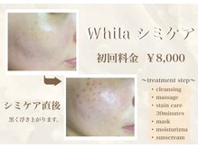 ホワラ 福岡天神店(Whila)の雰囲気（～シミケアトリートメントステップ～）