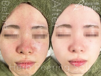 ベル 門前仲町(Belle)/ハーブピーリング|ニキビケア