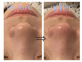 リジュベ(Rejuve)/毛穴洗浄/毛穴エステ/船橋/美肌