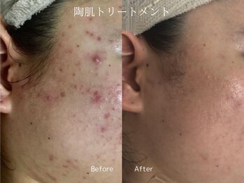 ヘアーアンドエステティック ヴェリス(hair&esthetic Velis)/陶肌トリートメント