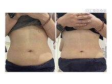 メディカルエステ 大宮店/＊日本初-12℃脂肪冷却症例＊