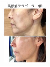 エクレクティック(ECLECTIC)/たるみ改善/宇都宮エステ