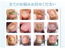 巻き爪補正店 神戸三宮店の雰囲気（変形爪・肥厚爪・変色した爪などの再生補正）