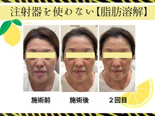 クリニカルエステ/イーズ パークプレイス大分店の雰囲気（【レモンボトル】お顔に合わせて3cc導入頬、顎下、目元脂肪へ！）