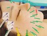 【微弱電流で顔をグングン引き上げる】EMSリフトアップ美容鍼 ¥13000→¥10000