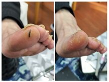 フレッシュフット(FreshFoot)/足のトラブルお任せください