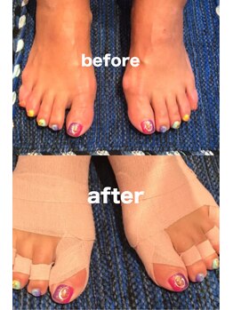 整足院/テーピング施術3