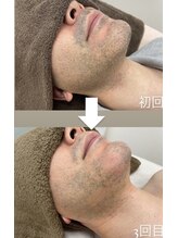 カルディエ(Cardie)/ひげ脱毛　ビフォーアフター