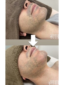 カルディエ(Cardie)/ひげ脱毛　ビフォーアフター