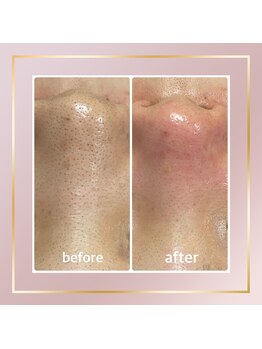 リシェス(Richesse)/毛穴ケア☆初回¥9990