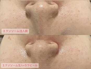 グラン ジュテ/毛穴に！臍帯エクソソーム注入