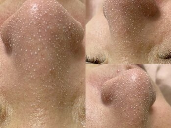 ヴィーヴ 京橋(vive)/【韓国式3D毛穴洗浄】